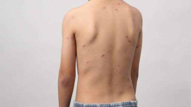A 7 year old Asian boy has chickenpox. pimples on the body of child with chickenpox