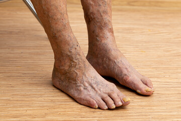 Unrecognizable elderly woman bare legs with protruding varix and nail fungus. Edema skin...