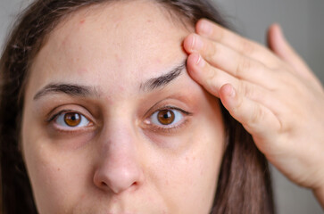 close up on white female face with some acne and dark circles, no make up