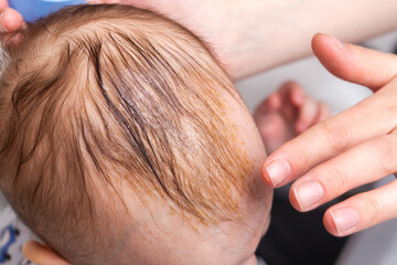 Smearing a seborrheic crust with baby oil on a child's head. Combing and removal of seborrheic crust, close-up