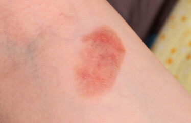 Fototapeta premium Red spot on the skin, skin damage from a burn on the arm. Close-up