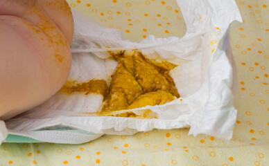 baby pooped in diaper, dirty diaper after bowel movements, close-up - obrazy, fototapety, plakaty