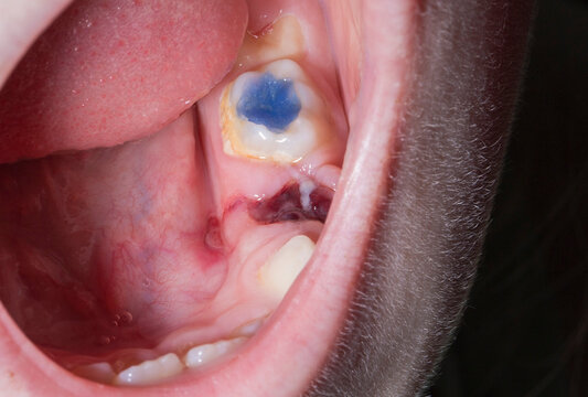 An open child's mouth with a pulled out tooth and blood in the gum. Extraction of milk teeth in children. Colored blue filling in the tooth, close-up