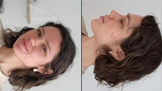 Vertical video. Two faces of young caucasian woman show real result before and after acne treatment. Split screen. Home background. Concept  of acne therapy, scars, inflammation on face, problem skin