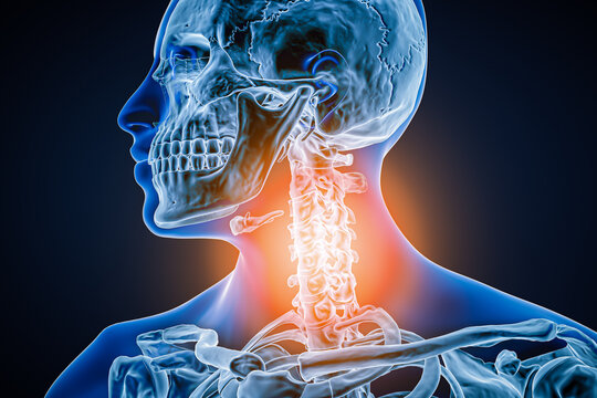 Cervical vertebrae with osteoarthritis, inflammation or injury 3D rendering illustration. Anatomy, spine pathology, articular pain or disease, rheumatism, medical and healthcare concept.