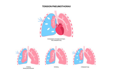 Fototapeta premium Tension pneumothorax poster