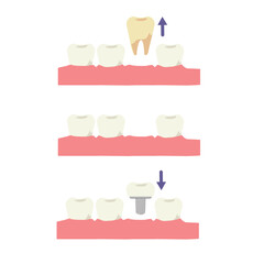 Dental medical concept. Tooth implant, Dental implant process . Flat cartoon Vector illustration