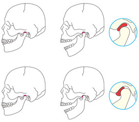 正常な顎関節と顎関節症の比較 © koti