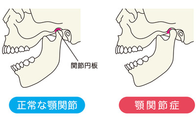 正常な顎関節と顎関節症の比較 - obrazy, fototapety, plakaty