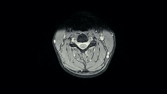 Magnetic Resonance images ( MRI ) of cervical spine sagittal. C5 ,C6, C7 injured disc disease