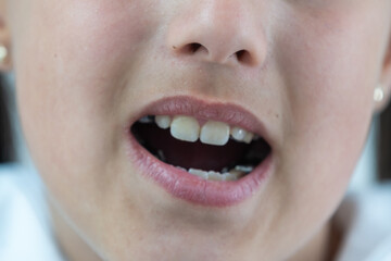 Obraz na płótnie Canvas a little girl with a shifted dentition demonstrates her teeth