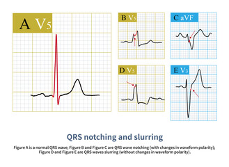 Normal ventricular depolarization produces smooth and sharp QRS waves; when local ventricular muscle depolarization is impaired, QRS notching and slurring are produced.