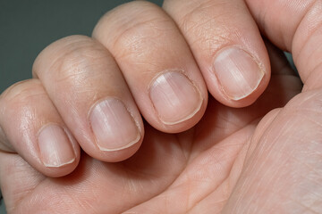 Overgrown unkempt nails on a woman's hand with a dry cuticle, requiring manicure care. Close-up, macro.