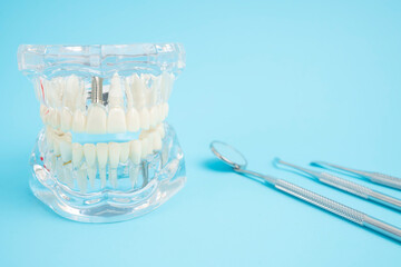 The Human jaw or Acrylic dentures model with implants and dental tools on blue background.