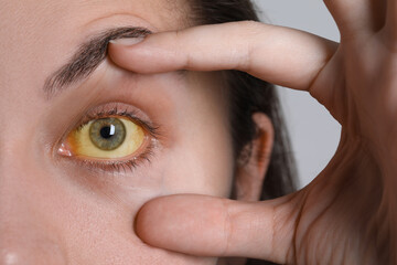Woman with yellow eyes on light background, closeup. Symptom of hepatitis