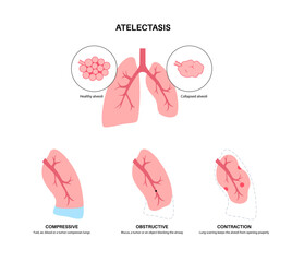 Atelectasis medical poster