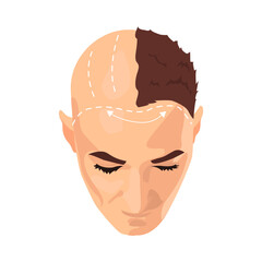 Hair transplantation illustration in color cartoon style. Editable vector graphic design.
