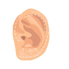 Otoplasty illustration in color cartoon style. Editable vector graphic design.