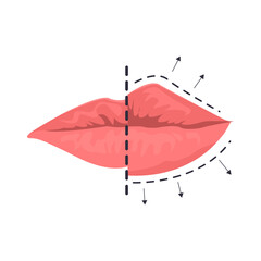 Lip augmentation illustration in color cartoon style. Editable vector graphic design.