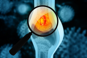 Bone cancer, knee joint, giant cell tumor of bone, osteosarcoma, a magnifying glass close up of a cancerous growth. 3d illustration