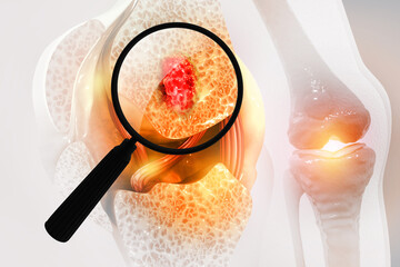 Bone cancer, knee joint, giant cell tumor of bone, osteosarcoma, a magnifying glass close up of a cancerous growth. 3d illustration