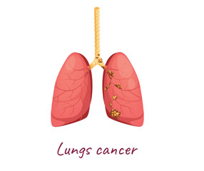 Concept Human anatomy organ lungs illness. The illustration is a flat and cartoon-style vector graphic of a pair of lungs with cancer, designed on a white background. Vector illustration.