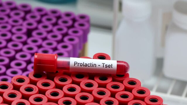 Prolactin test to look for abnormalities from blood,  blood sample to analyze in the laboratory, blood in test tube