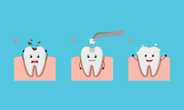 Dental Step of restoring cavity tooth by filling tooth illustration cartoon character vector design on blue background. Dental care concept.
