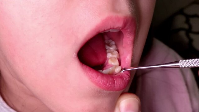 Pediatric dentist examines a loose milk tooth in a child	
