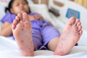 Enterovirus foot red spots blisters on the skin of on the body of a purple uniform child virus on bed at hospital