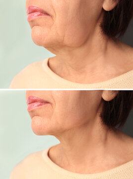 Double chin problem. Collage with photos of mature woman before and after skin tightening treatments on light grey background, closeup