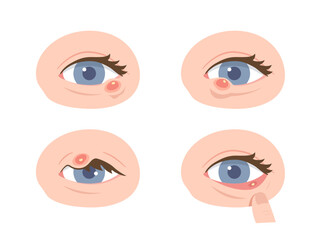 Set of various locations of stye eye. Concept of Hordeolum, infectious eye, Ophthalmology, medical illustration, health care. Flat vector illustration.