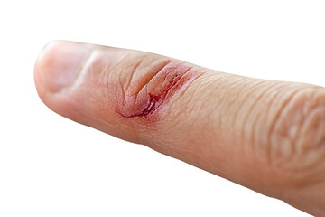 A finger that was injured by a knife and was bleeding.