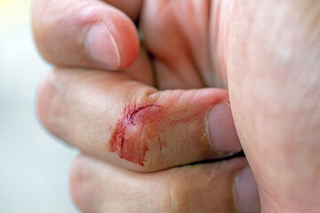 A finger that was injured by a knife and was bleeding.