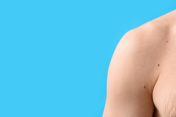 Young man with moles on blue background, closeup