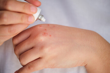 Woman applying white medical corticosteroid ointment on eczema on her hand. Dermatitis, allergy, psoriasis concept.