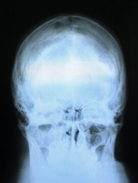 X-ray image of the skull from the back. X-ray of a man's head. Medical examination of head injuries.