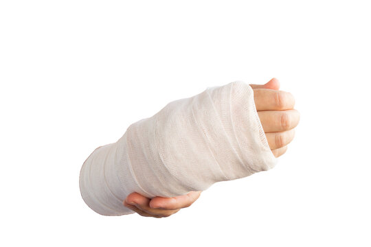 Close-up of a broken arm of a woman in a cast isolated transparent png.