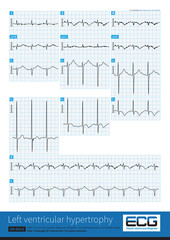 The typical ECG for left ventricular hypertrophy is left ventricular high voltage, sometimes with significant ST-T changes, U-wave changes, and QT interval prolongation.
