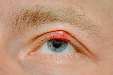 Eye sick, eyelid sick. Demodicosis mite diseas, demodex. Chalazion on eyelid. Eye treatment....