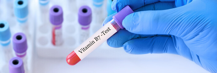 Doctor holding a test blood sample tube with Vitamin B7 test on the background of medical test tubes with analyzes
