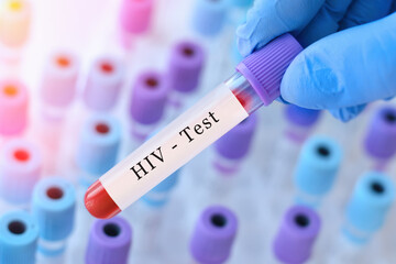 Doctor's hand holds test tube in blood on the background of test tubes with analyzes.Blood sample with HIV testing