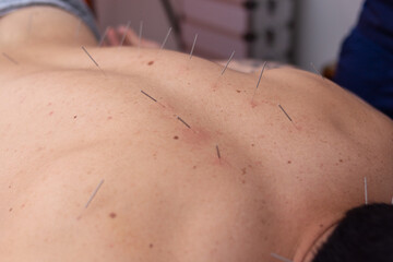 Acupuncture Session