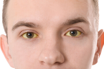 Man with yellow eyes on white background, closeup. Symptom of hepatitis