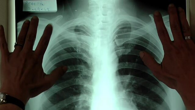 X-ray of Chest, Doctor Examining X-ray of Chest in Hospital. Close Up.