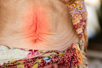 Abdominoplasty scars of an elderly woman with abdominal disease problems such as gastritis or...