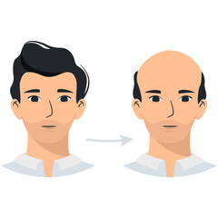 Before and after baldness with man head, hair loss stages, male androgenetic alopecia png