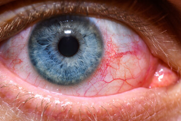 Czerwone oko od alergii z popękanymi naczynkami - obrazy, fototapety, plakaty