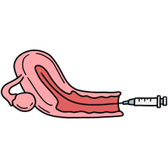 Embryo transfer into a woman's uterus at In Vitro fertilization