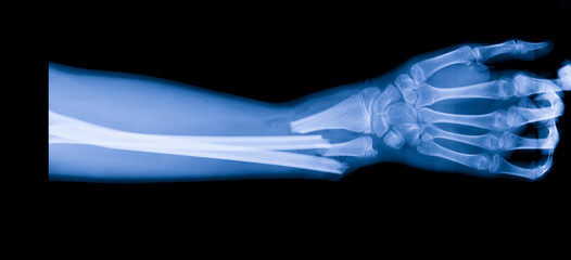 Forearm x ray after car accident in orthopedic unit inside trauma hospital.X-ray shows radius and...